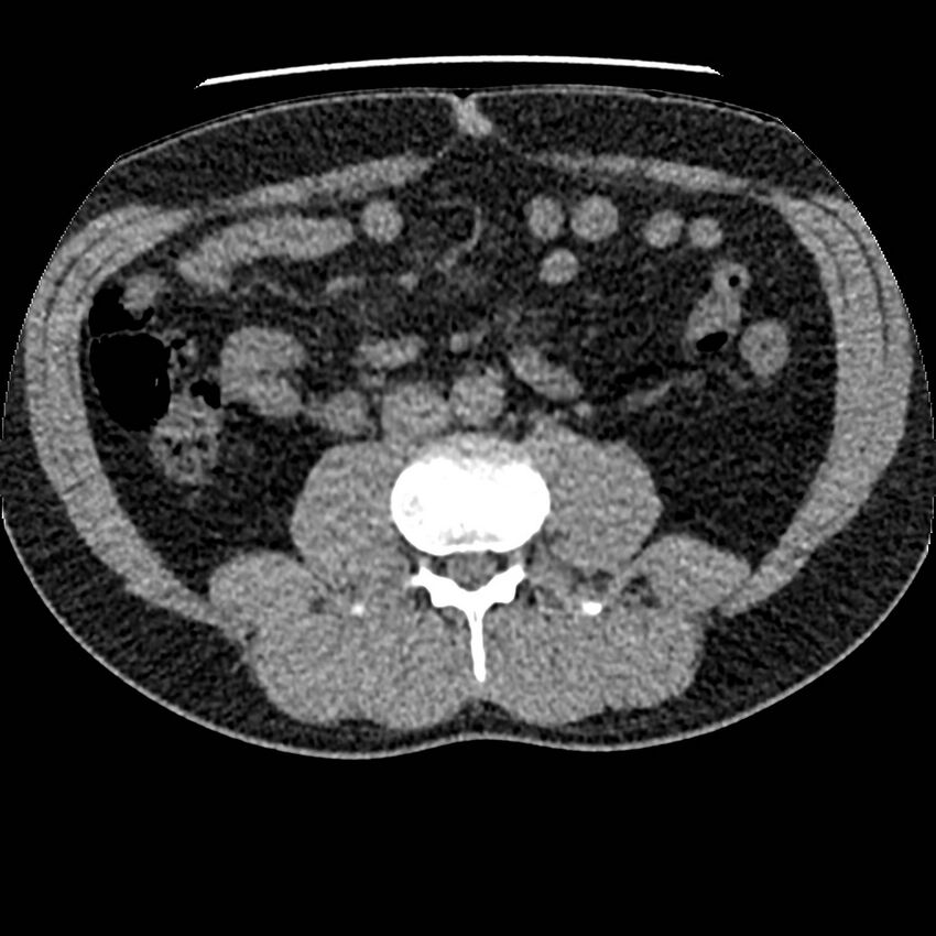 Obstructing ureteric calculus and ureteric anatomy (Radiopaedia 62730-71042 Axial non-contrast 70).jpg