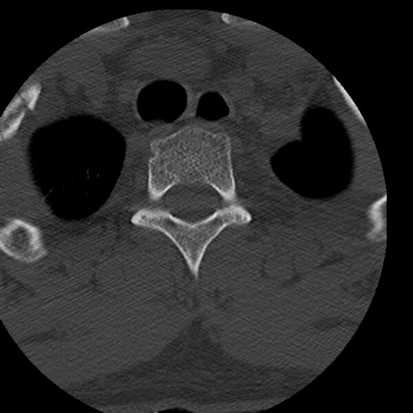 File:Occipital condyle fracture (Radiopaedia 31755-32691 Axial bone window 87).jpg