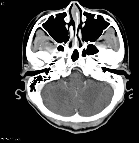 File:Occipital condyle metastasis - into mastoid (Radiopaedia 5424-7177 B 10).jpg
