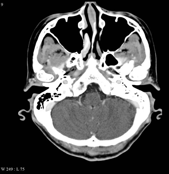 File:Occipital condyle metastasis - into mastoid (Radiopaedia 5424-7177 B 9).jpg