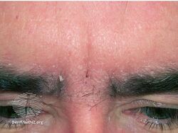 Seborrhoeic dermatitis around eyebrows