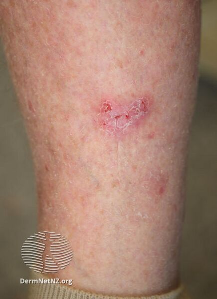 File:Superficial basal cell carcinoma, leg (DermNet NZ sbcc-leg-18-dn).jpg