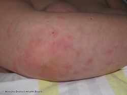 Sweet disease caused by vemurafenib