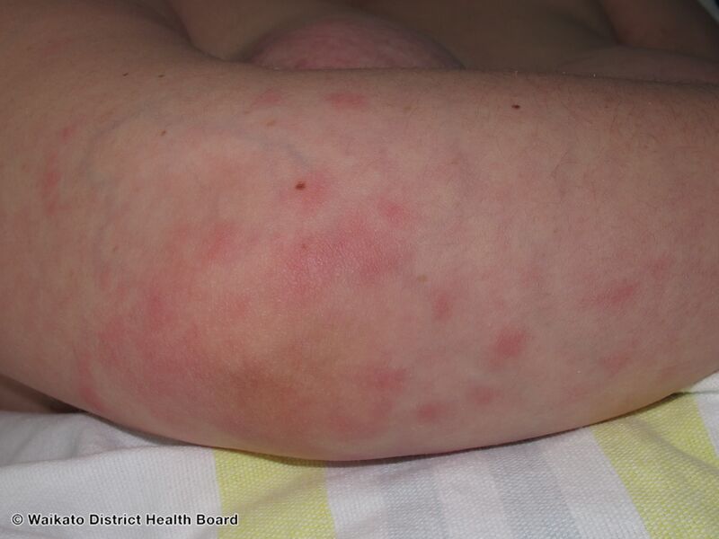 File:Sweet disease caused by vemurafenib (DermNet NZ sweet-vemurafenib).jpg