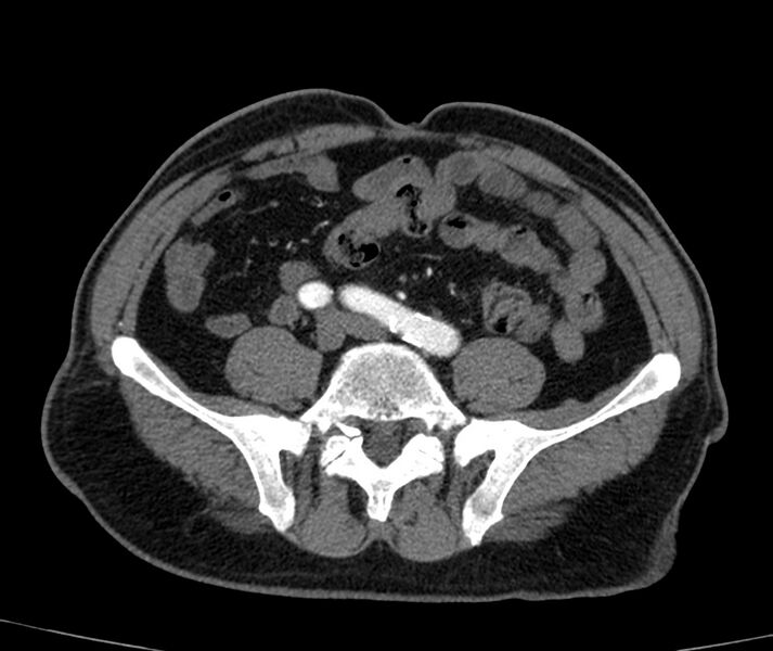 File:Abdominal aortic aneurysm (Radiopaedia 22421-22458 C+ arterial phase 65).jpg