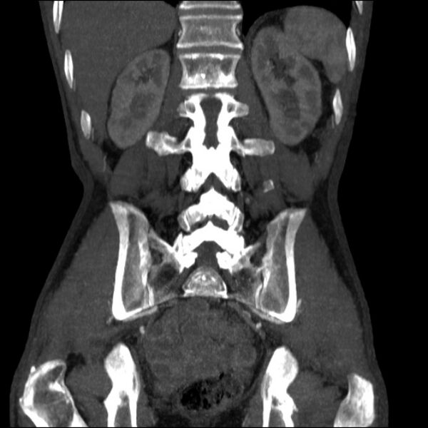 File:Abdominal aortic aneurysm (Radiopaedia 23703-23856 Coronal C+ arterial phase 26).jpg