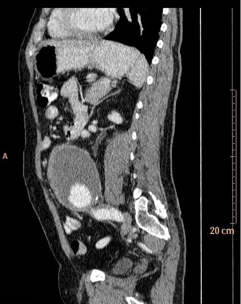 File:Abdominal aortic aneurysm (Radiopaedia 25985-26121 Sagittal C+ arterial phase 3).jpg
