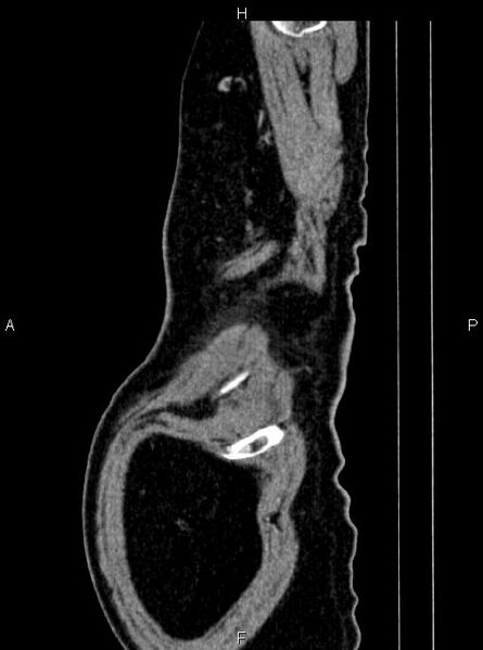 File:Abdominal aortic aneurysm (Radiopaedia 83094-97462 Sagittal renal cortical phase 120).jpg