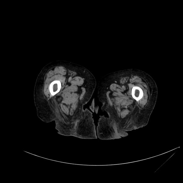 File:Abdominal aortic aneurysm - impending rupture (Radiopaedia 19233-19246 Axial non-contrast 150).jpg