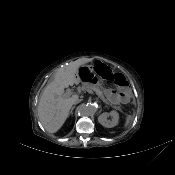 File:Abdominal aortic aneurysm - impending rupture (Radiopaedia 19233-19246 Axial non-contrast 39).jpg
