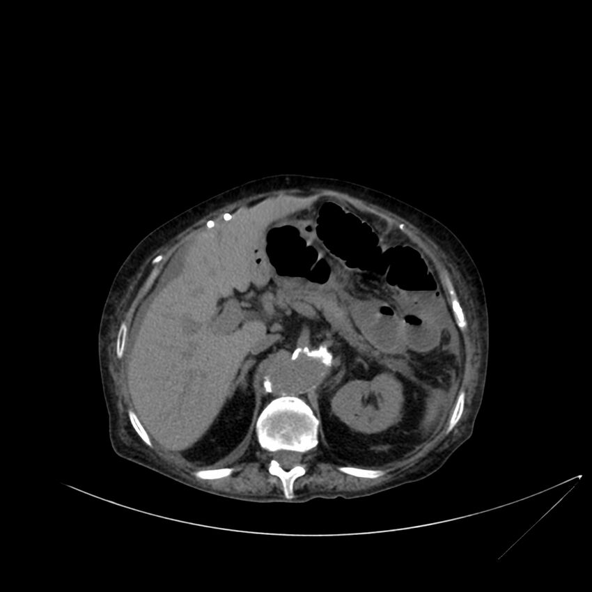 Abdominal aortic aneurysm - impending rupture (Radiopaedia 19233-19246 Axial non-contrast 39).jpg