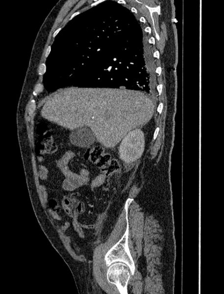 File:Abdominal aortic aneurysm rupture (Radiopaedia 54179-60362 Sagittal C+ arterial phase 9).jpg
