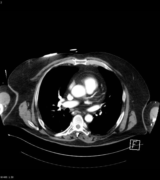 File:Abdominal aortic aneurysm with intramural hematoma then rupture (Radiopaedia 50278-55632 Axial C+ arterial phase 1).jpg