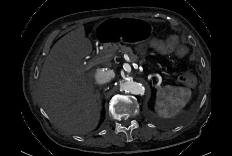 File:Abdominal aortic aneurysm with thrombus fissuration (Radiopaedia 73192-83919 Axial C+ arterial phase 31).jpg