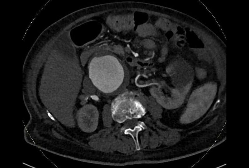 File:Abdominal aortic aneurysm with thrombus fissuration (Radiopaedia 73192-83919 Axial C+ arterial phase 66).jpg