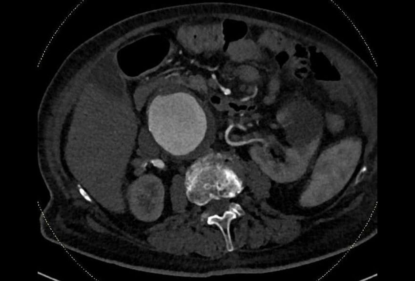 Abdominal aortic aneurysm with thrombus fissuration (Radiopaedia 73192-83919 Axial C+ arterial phase 66).jpg