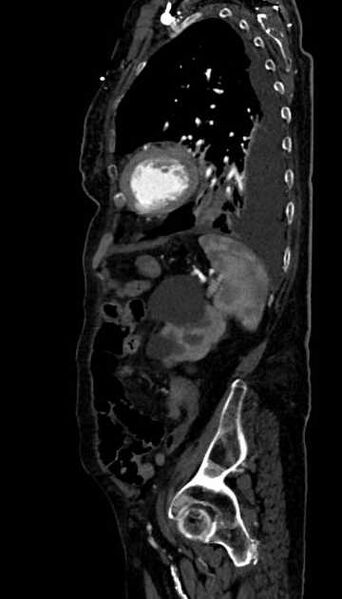 File:Abdominal aortic aneurysm with thrombus fissuration (Radiopaedia 73192-83919 Sagittal C+ arterial phase 30).jpg