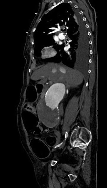 File:Abdominal aortic aneurysm with thrombus fissuration (Radiopaedia 73192-83919 Sagittal C+ arterial phase 90).jpg