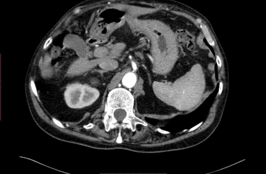 Abdominal aortic interposition tube graft and aneurysm thrombosis (Radiopaedia 71438-81857 Axial C+ arterial phase 15).jpg