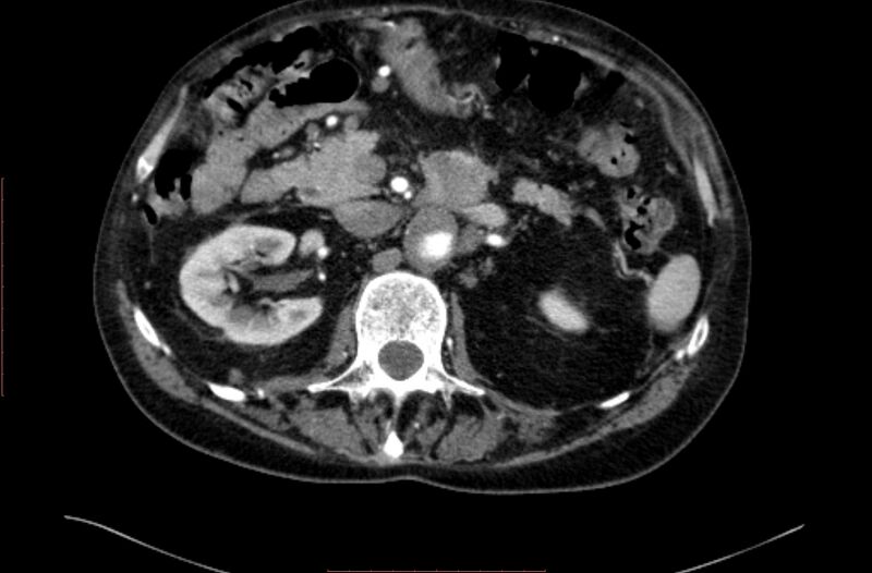 File:Abdominal aortic interposition tube graft and aneurysm thrombosis (Radiopaedia 71438-81857 Axial C+ arterial phase 43).jpg