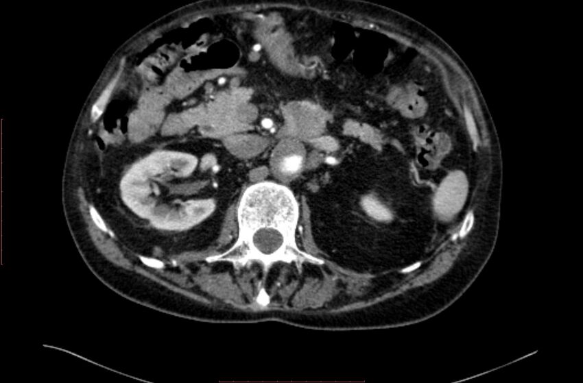 Abdominal aortic interposition tube graft and aneurysm thrombosis (Radiopaedia 71438-81857 Axial C+ arterial phase 43).jpg