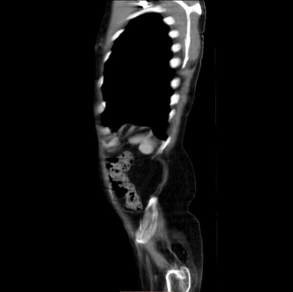 File:Abdominal aortic interposition tube graft and aneurysm thrombosis (Radiopaedia 71438-81857 Sagittal C+ arterial phase 1).jpg
