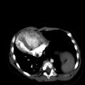 Aberrant left pulmonary artery (pulmonary sling) (Radiopaedia 42323-45435 Axial C+ CTPA 33).jpg