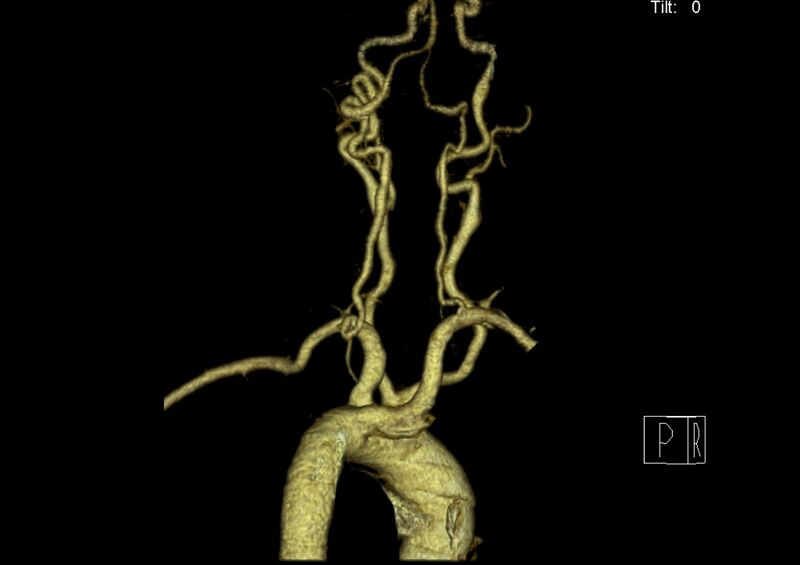 File:Aberrant right subclavian artery (Radiopaedia 19283-19294 3D reconstruction C+ arterial phase 24).jpg