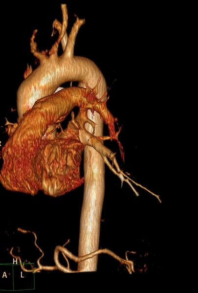 File:Aberrant right subclavian artery (Radiopaedia 67135-76475 B 12).jpg