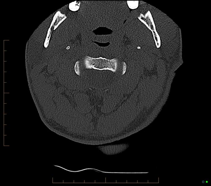File:Accessory articulation of cervical transverse processes (Radiopaedia 82715-96933 Axial non-contrast 26).jpg