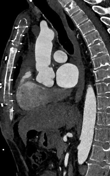 File:Accessory left atrial appendage (Radiopaedia 81987-95968 Sagittal C+ arterial phase 58).jpg