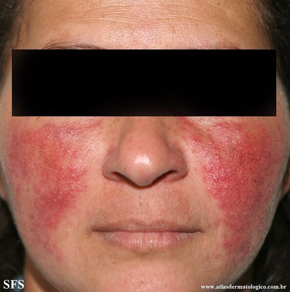 File:Acne Rosacea (Dermatology Atlas 21).jpg