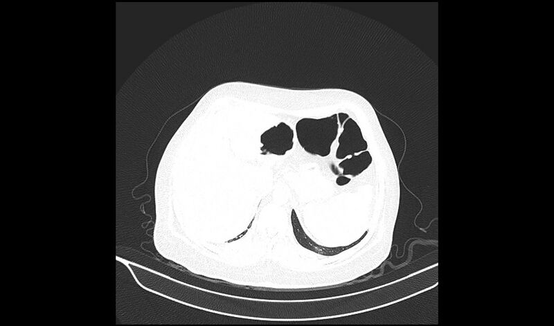 File:Acquired tracheo-esophageal fistula (Radiopaedia 51356-57103 Axial lung window 40).jpg