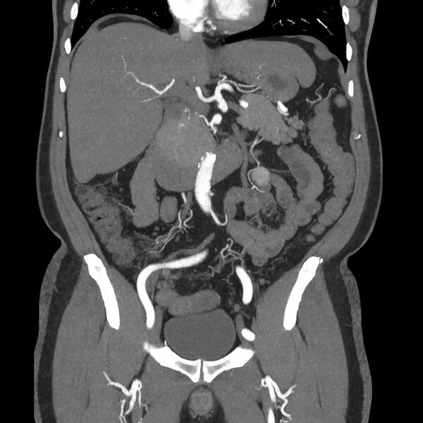 File:Active colonic bleed on CT (Radiopaedia 49765-55025 Coronal art MIP 31).jpg