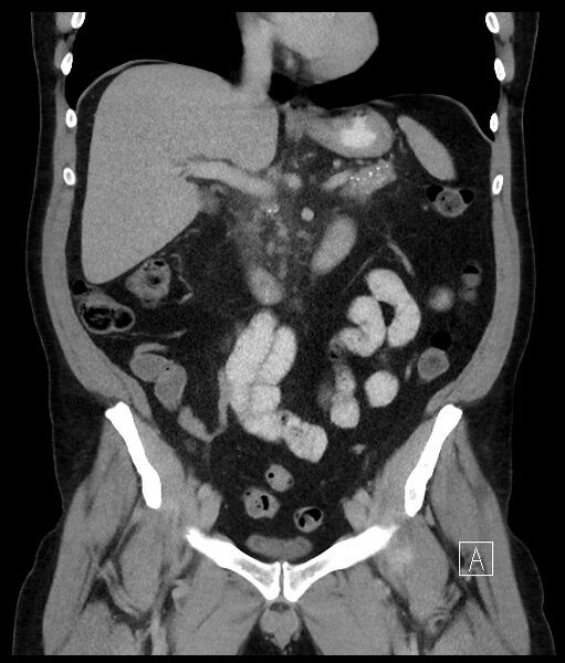File:Acute-on-chronic pancreatitis (Radiopaedia 67286-76656 Coronal C+ portal venous phase 39).jpg