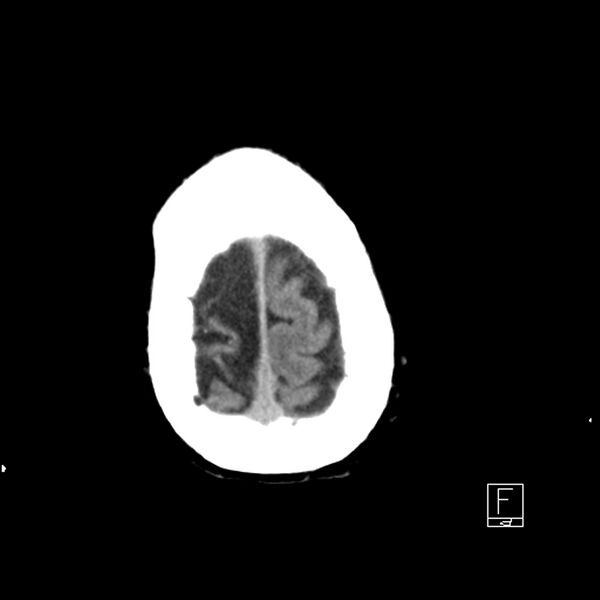 File:Acute ICA ischemic penumbra due to high-grade CCA stenosis (CT perfusion) (Radiopaedia 72038-82529 Axial non-contrast 44).jpg