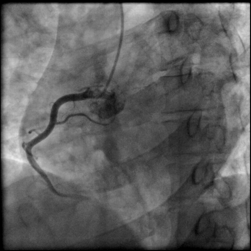 Acute anteroseptal myocardial infarction (Radiopaedia 68409-77946 RAO straight RCA 15).jpg