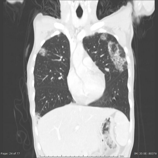 File:Acute eosinophilic pneumonia (Radiopaedia 48211-53073 Coronal 23).jpg