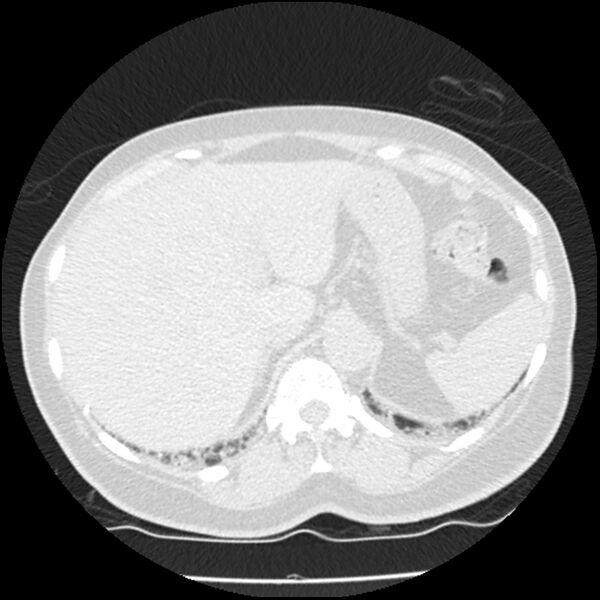 File:Acute interstitial pneumonitis (Radiopaedia 45404-49444 Axial lung window 93).jpg
