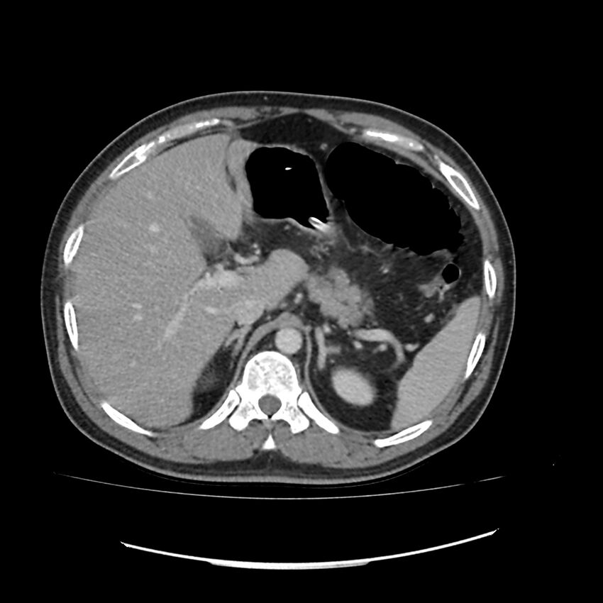 Acute mesenteric ischemia - superior mesenteric artery thrombosis (Radiopaedia 73947-84776 Axial C+ portal venous phase 11).jpg