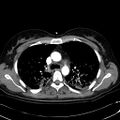 Acute myocardial infarction in CT (Radiopaedia 39947-42415 Axial C+ arterial phase 46).jpg