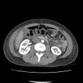 Acute myocarditis (Radiopaedia 55988-62613 Axial C+ portal venous phase 36).jpg