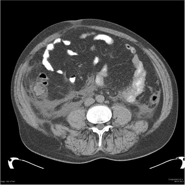 File:Acute pancreatitis (Radiopaedia 19135-19116 Axial non-contrast 35).jpg
