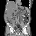 Acute pancreatitis (Radiopaedia 19135-19116 Coronal non-contrast 23).jpg