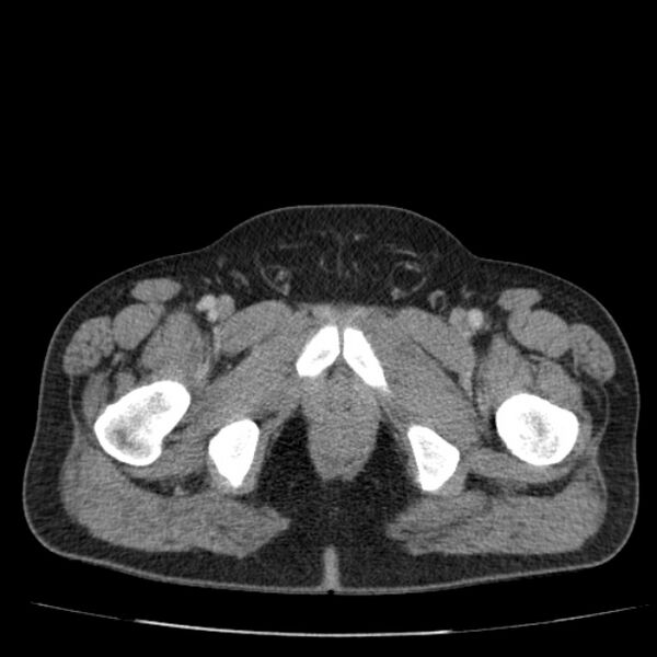 File:Acute pancreatitis (Radiopaedia 26663-26813 Axial C+ portal venous phase 90).jpg