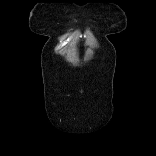 File:Acute pancreatitis - Balthazar C (Radiopaedia 26569-26714 Coronal C+ portal venous phase 10).jpg
