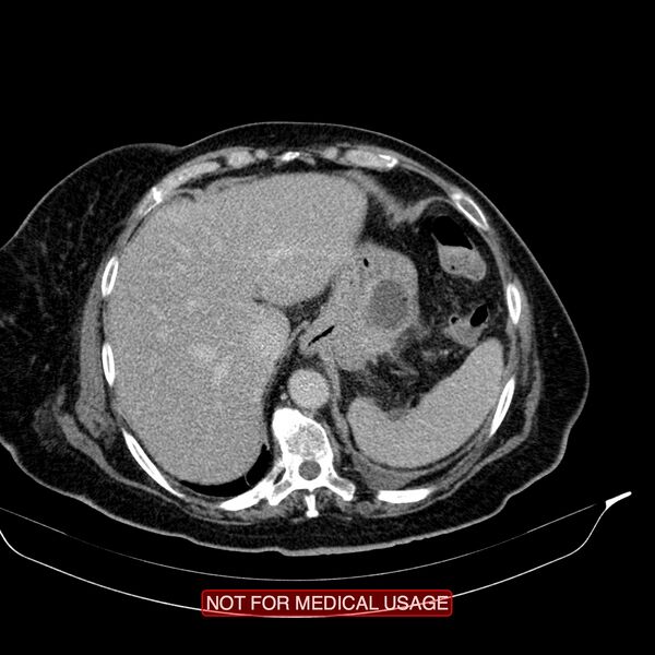File:Acute pancreatitis with infected necrosis (Radiopaedia 26454-26585 Axial C+ delayed 2).jpg