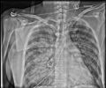 Acute pulmonary edema on CT (Radiopaedia 33582-34673 B 1).jpg