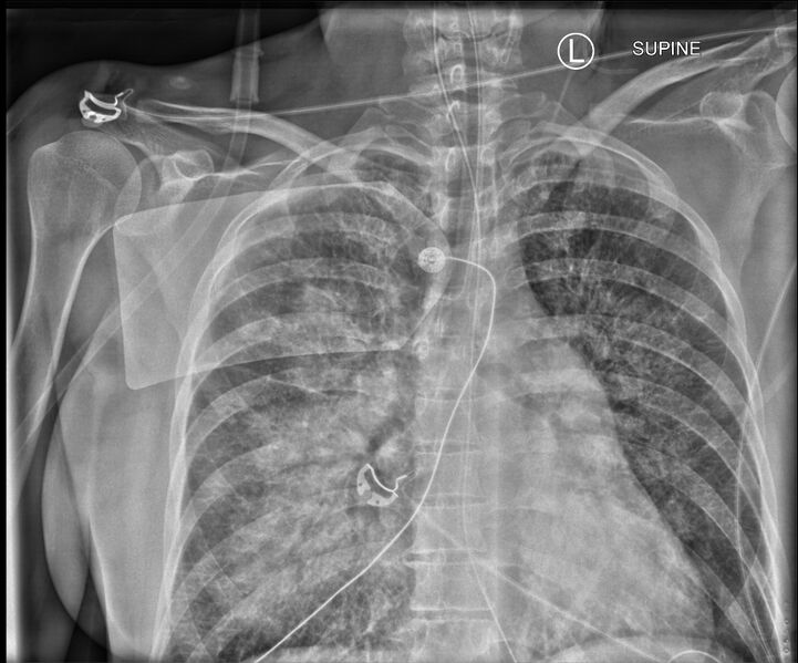 File:Acute pulmonary edema on CT (Radiopaedia 33582-34673 B 1).jpg