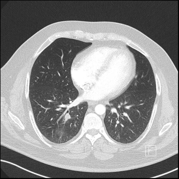 File:Acute pulmonary embolism with pulmonary infarct (Radiopaedia 73062-83768 Axial lung window 5).jpg